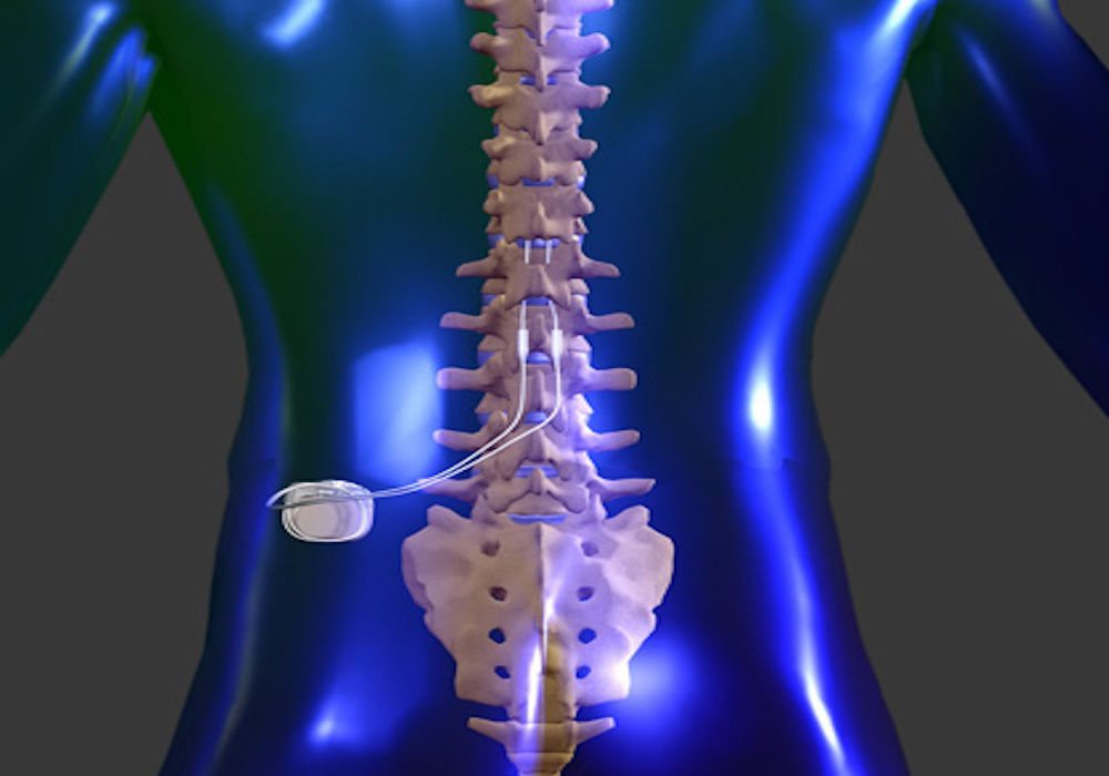 Spinal Cord Stimulation Device Visualization