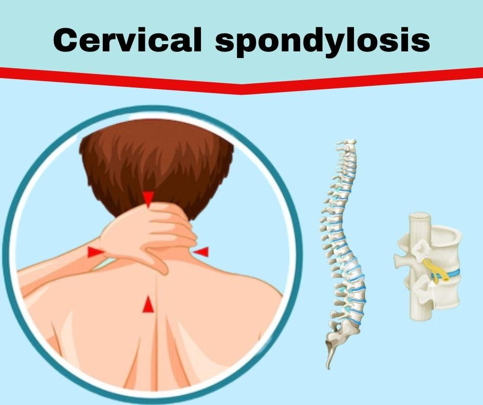Spondylosis