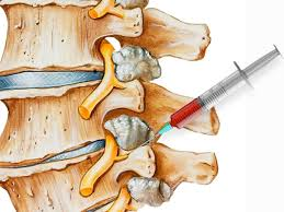 Facet Joint Injection