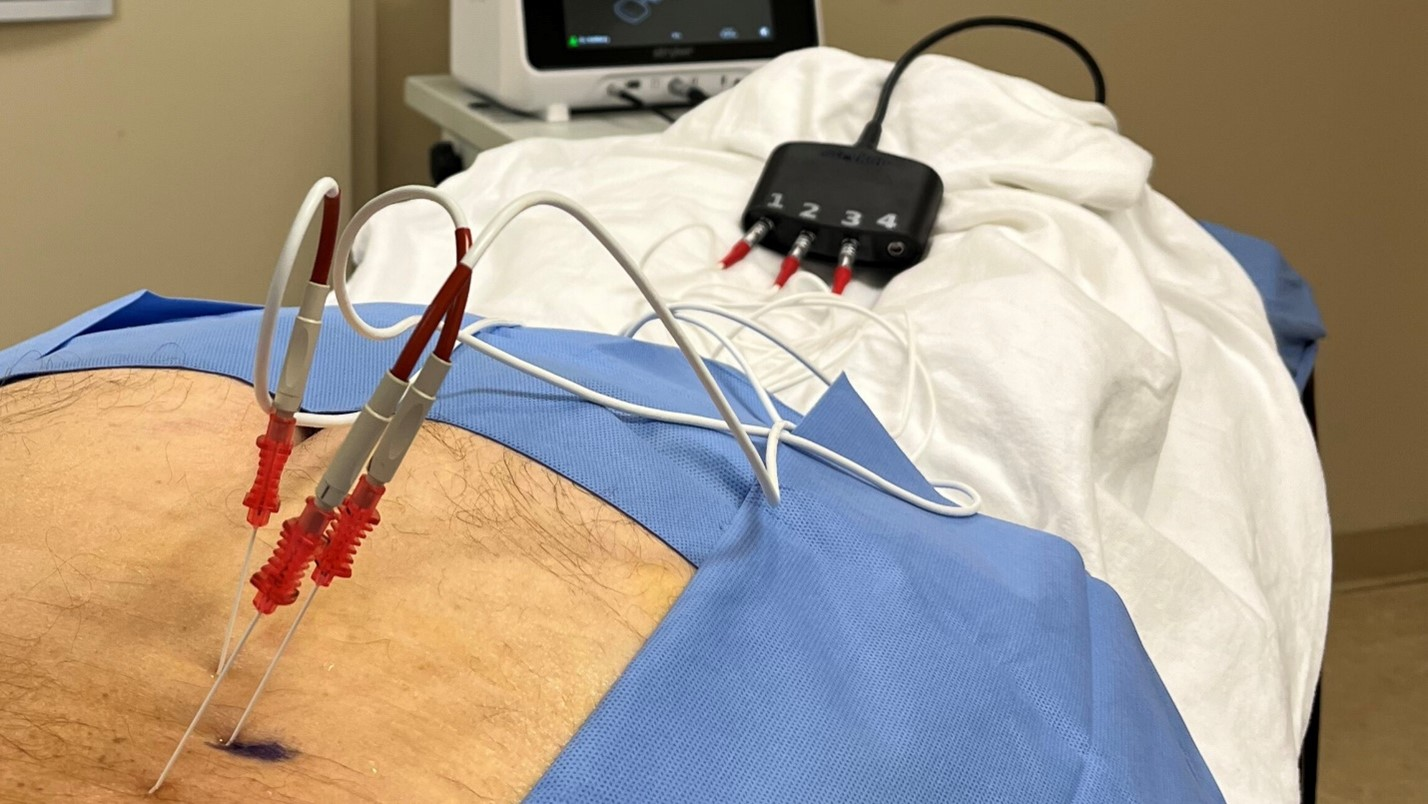 Radiofrequency Ablation