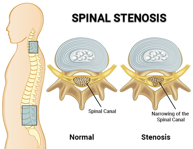 Spinal Stenosis