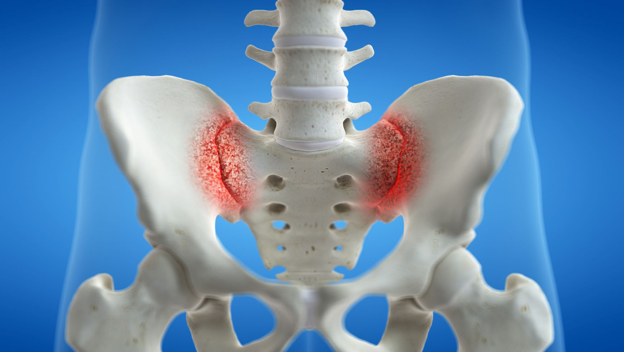 Sacroiliac Joint Fusion SI Fusion