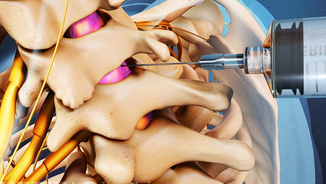 Epidural Steroid Injection