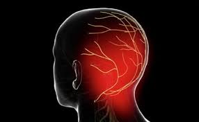 Occipital Neuralgia